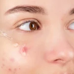 טיפול באקנה – איך לטפל נכון ולמנוע התפרצויות