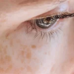 מה זה פיגמנטציה וכתמי עור – גורמים, סוגים ודרכי טיפול