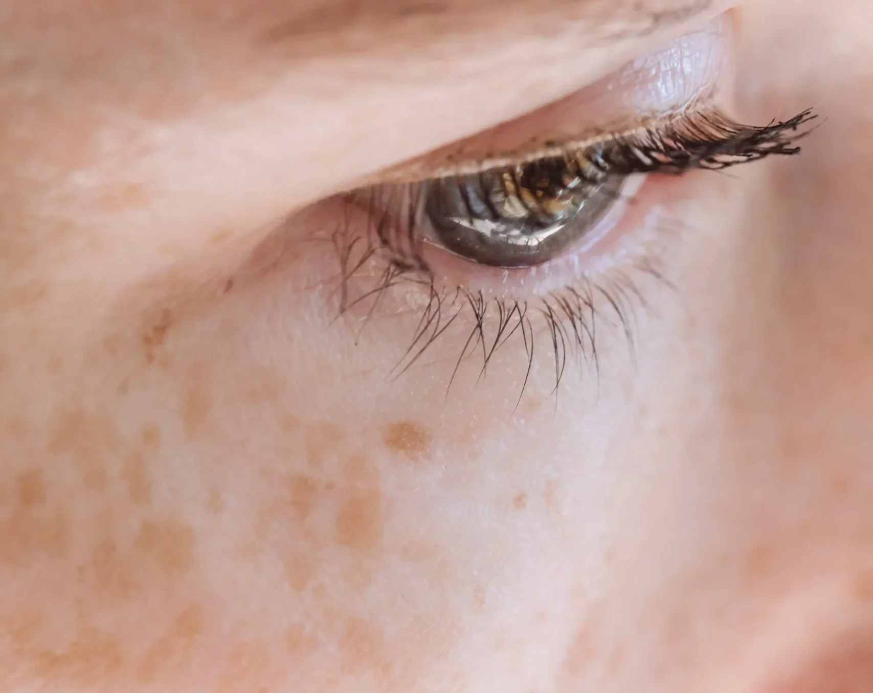 מה זה פיגמנטציה וכתמי עור – גורמים, סוגים ודרכי טיפול