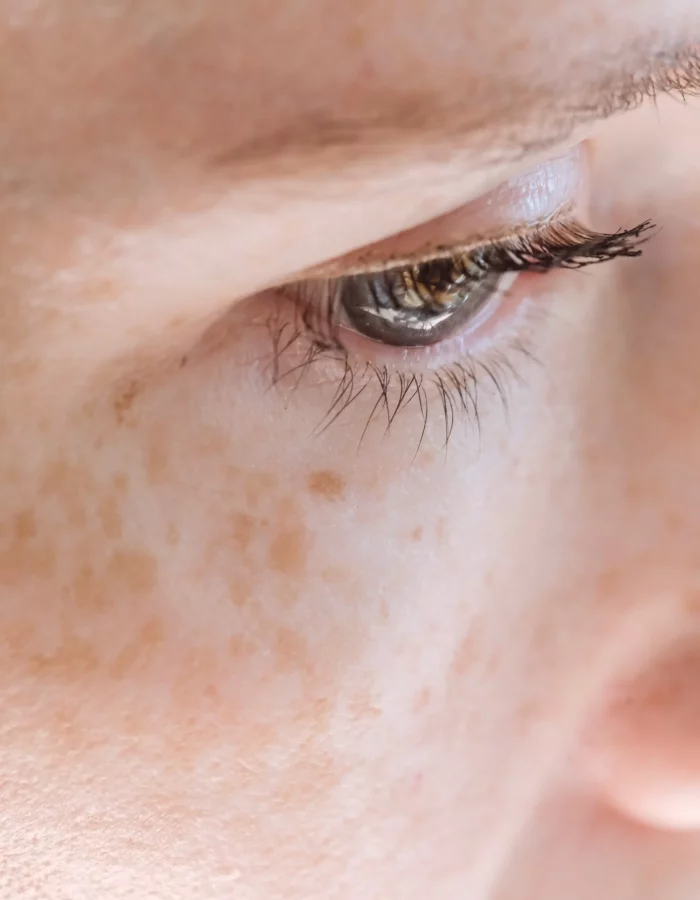 pigmentation-article פיגמנטציה
